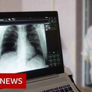 Some long Covid patients may have hidden damage to their lungs - BBC News